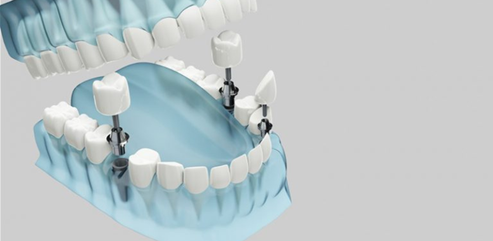 Full Mouth Dental Implants