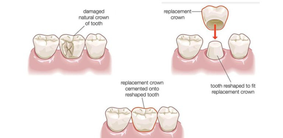 Everything you need to know about Dental Crowns