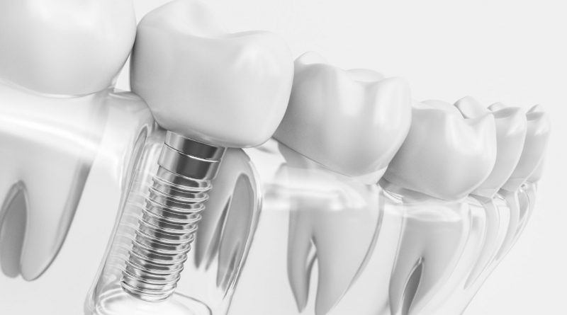 Importance of dental implants