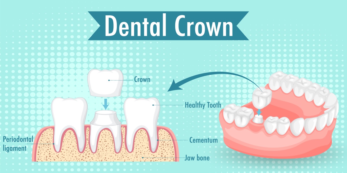 Teeth Crowns