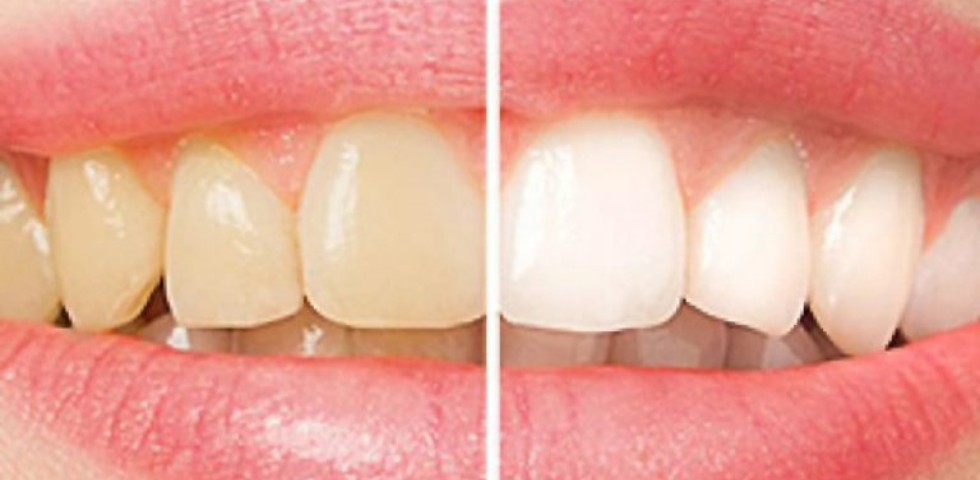 Don’t want metal? No problem! Learn the benefits of Invisalign