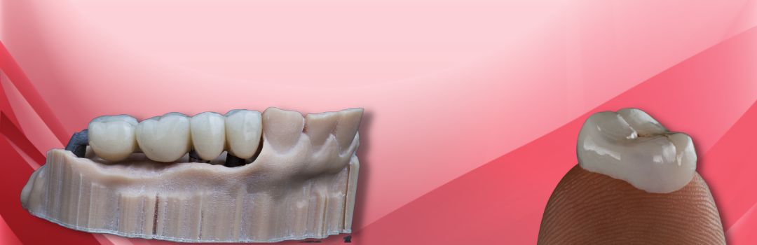 Dental Crowns and Bridges Treatment