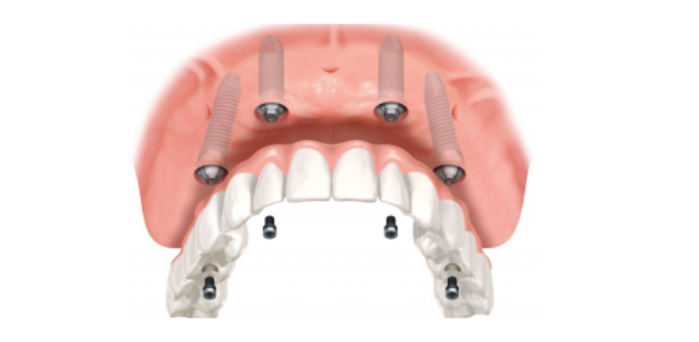 Dentures: what you need to know about them and how to care for them