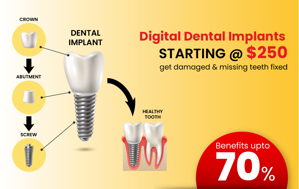 Digital Dental Implants pricing