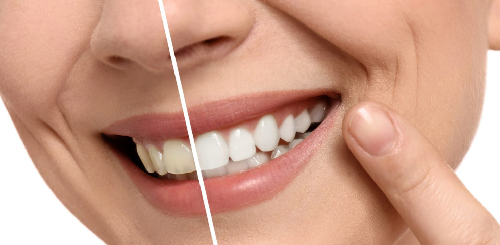before & After teeth whitening